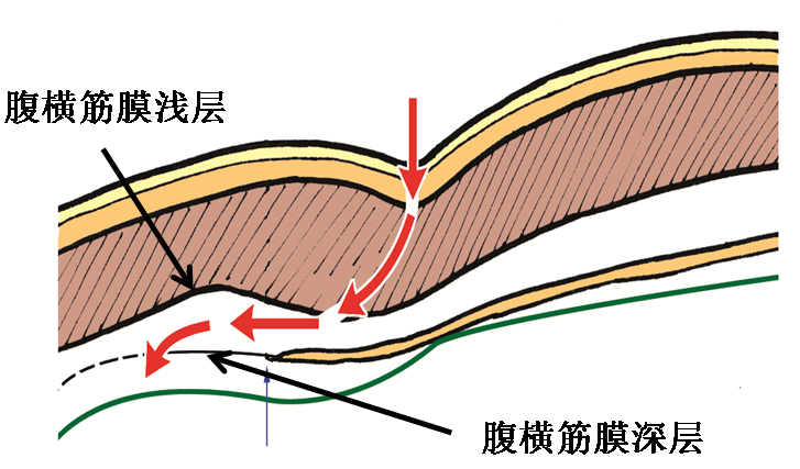 產(chǎn)后腹直肌分離如何康復(fù)，腹直肌修復(fù)那點事