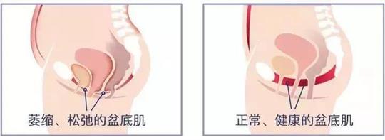 尿失禁治療儀器，不再詢問盆底康復(fù)治療有用嗎這類無意義問題