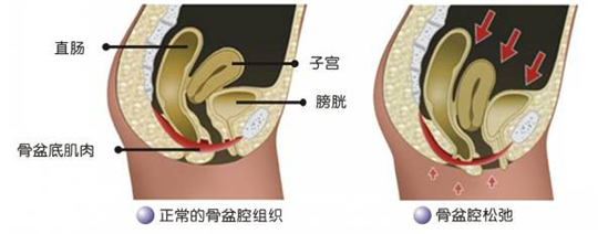 盆底功能檢測很重要，盆底肌松弛了會有什么表現(xiàn)呢？